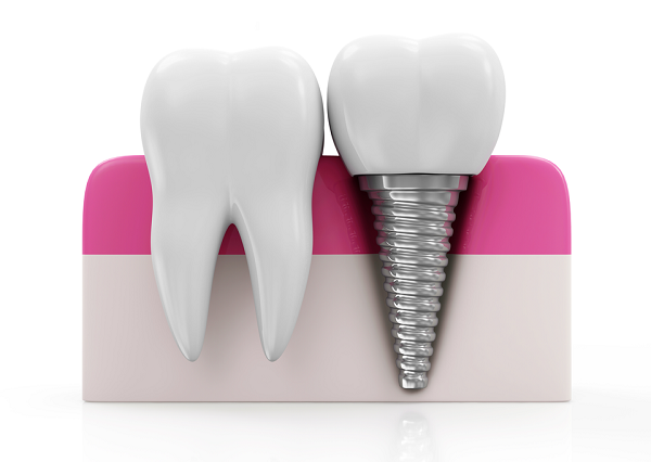 implants-dental